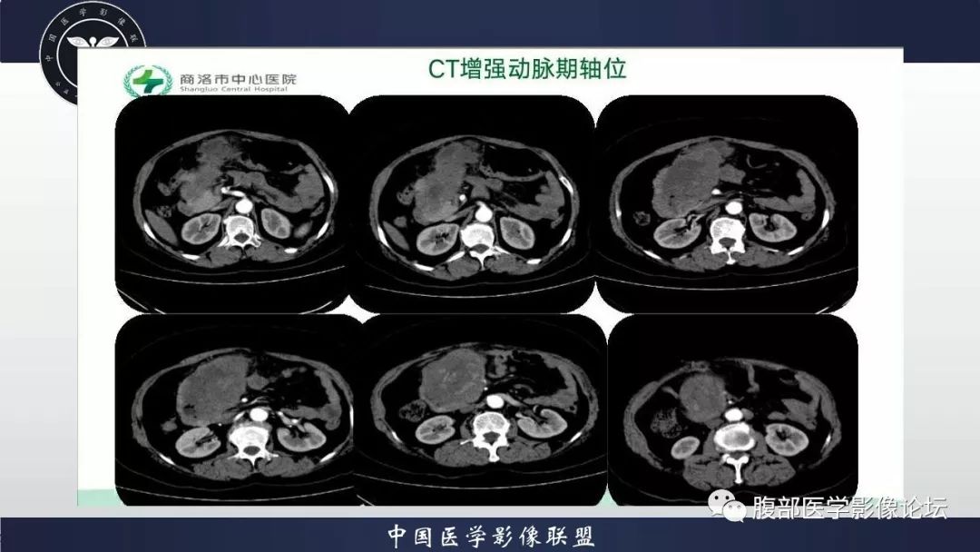 【病例】小肠间质瘤1例CT影像