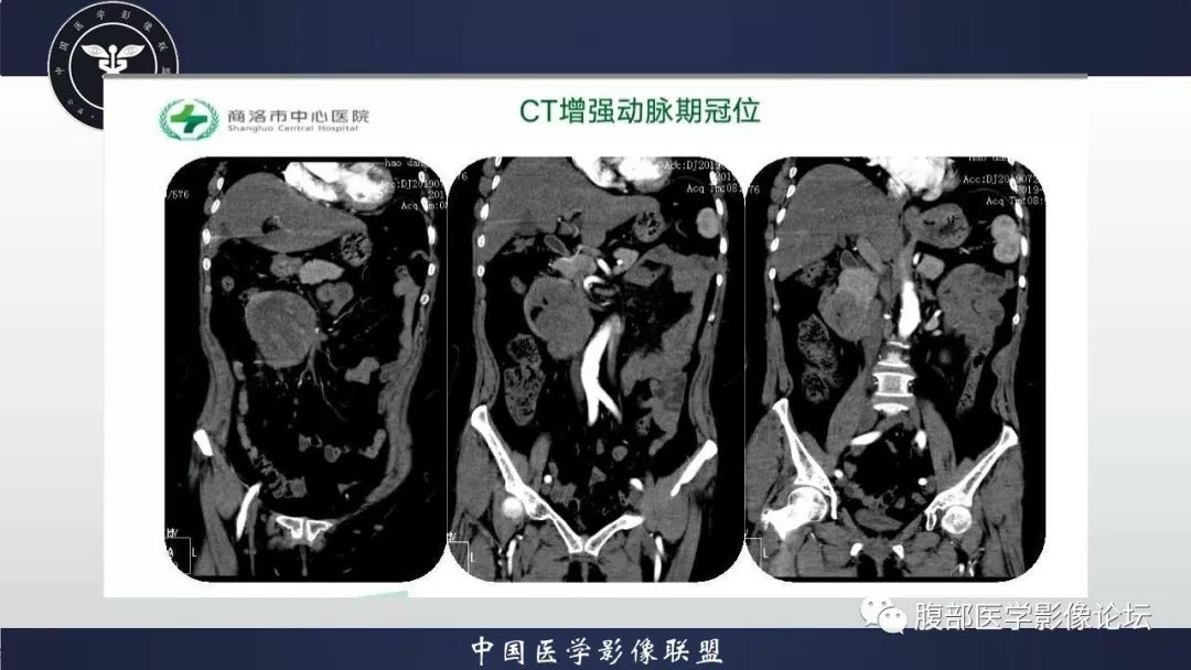 【病例】小肠间质瘤1例CT影像