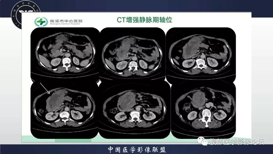 【病例】小肠间质瘤1例CT影像