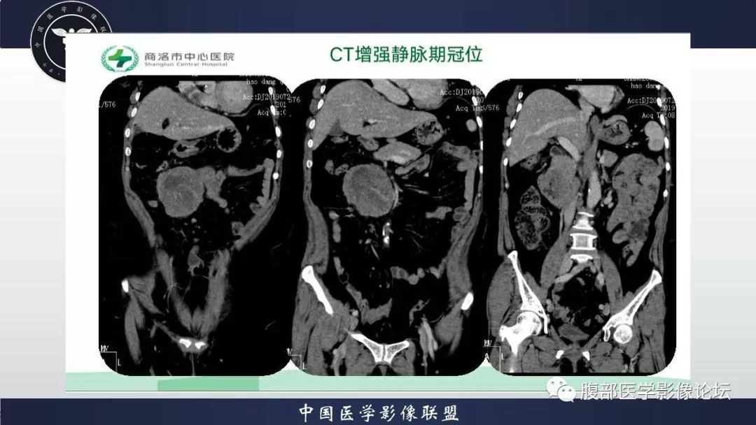 【病例】小肠间质瘤1例CT影像
