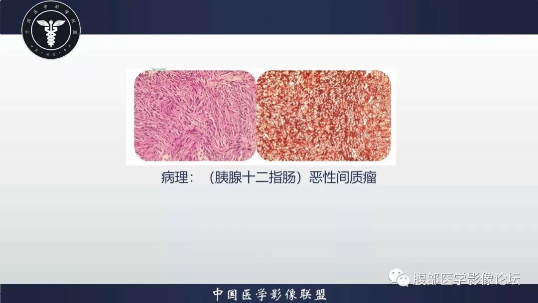 【病例】小肠间质瘤1例CT影像