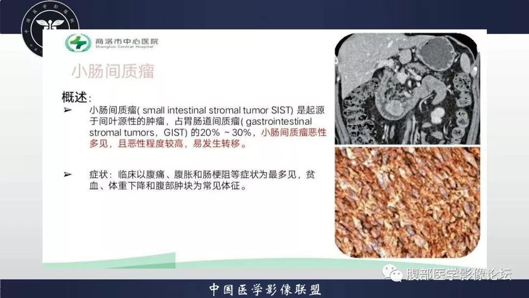 【病例】小肠间质瘤1例CT影像