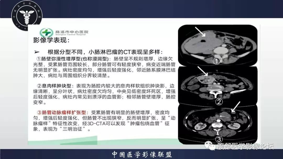 【病例】小肠间质瘤1例CT影像