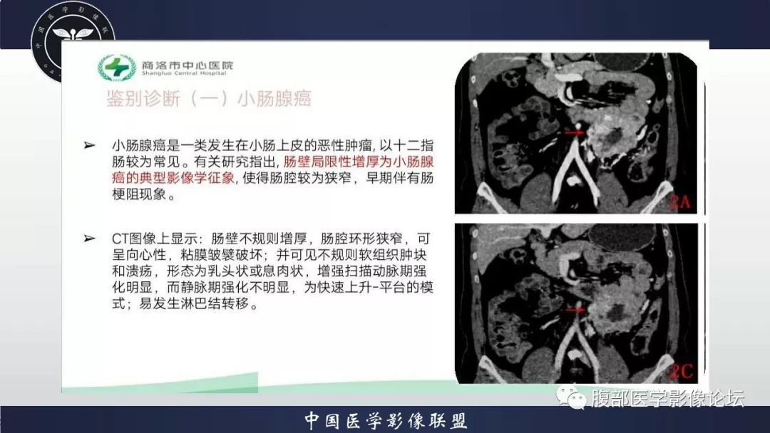 【病例】小肠间质瘤1例CT影像