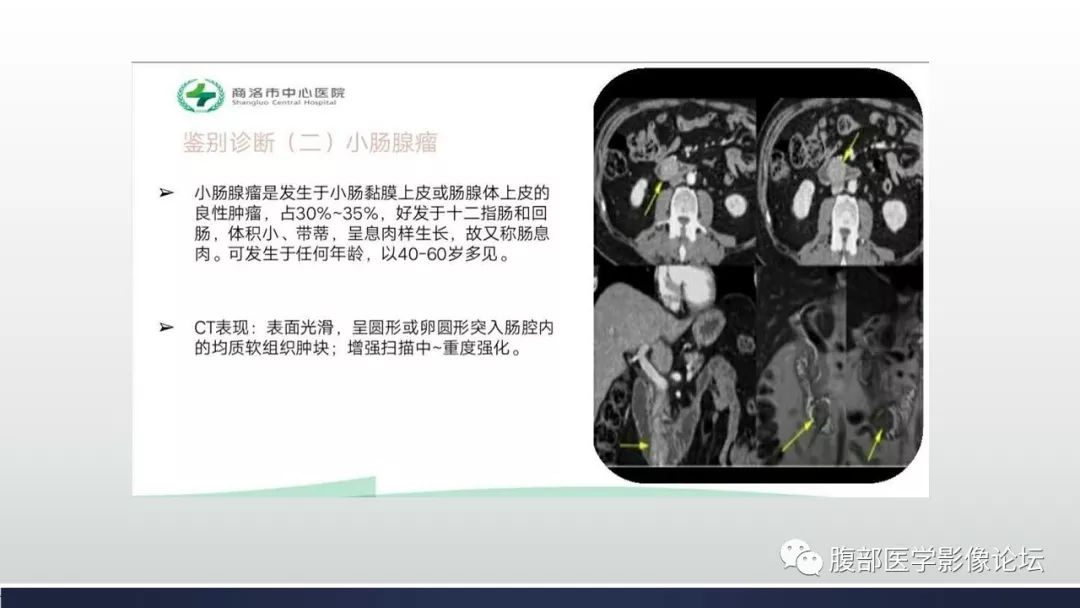 【病例】小肠间质瘤1例CT影像