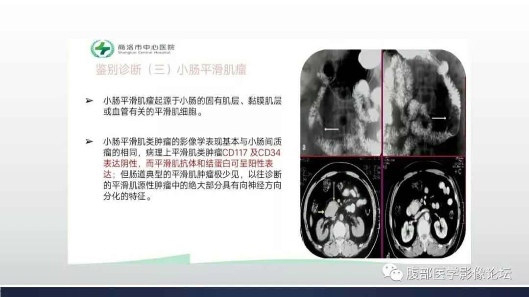 【病例】小肠间质瘤1例CT影像