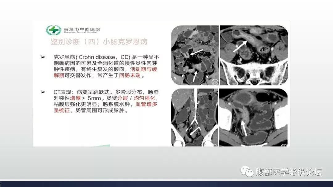 【病例】小肠间质瘤1例CT影像
