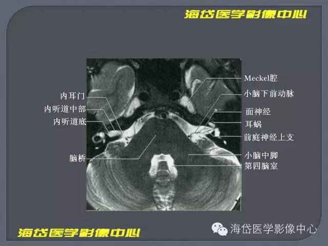 【PPT】基于MR增强扫描的桥小脑角区病变的影像学诊断