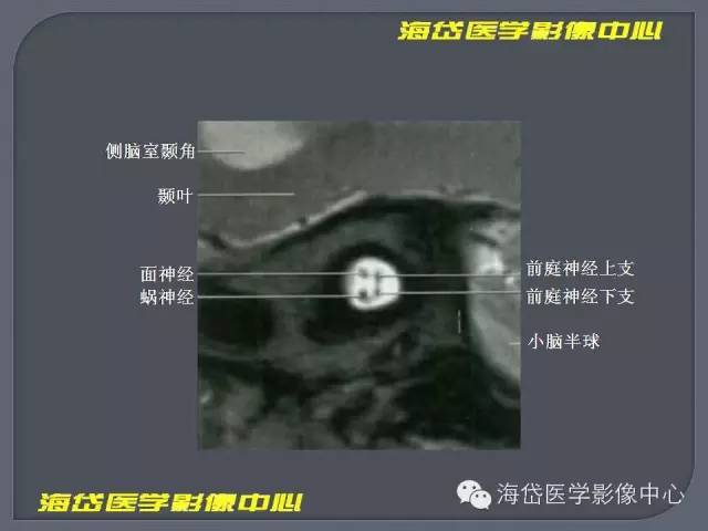 【PPT】基于MR增强扫描的桥小脑角区病变的影像学诊断