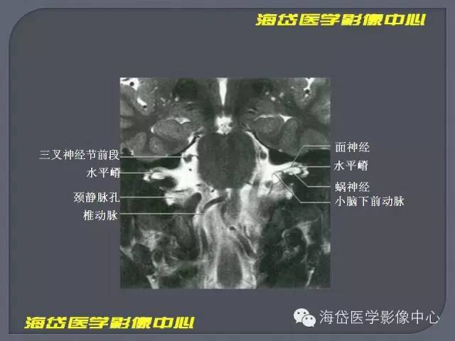 【PPT】基于MR增强扫描的桥小脑角区病变的影像学诊断