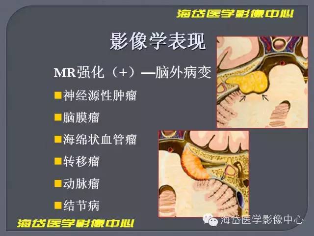 【PPT】基于MR增强扫描的桥小脑角区病变的影像学诊断