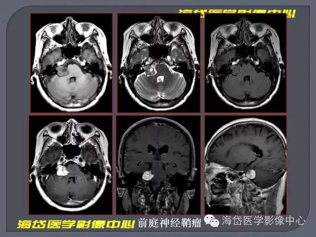 【PPT】基于MR增强扫描的桥小脑角区病变的影像学诊断