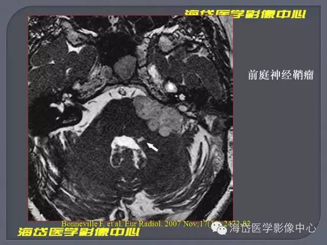 【PPT】基于MR增强扫描的桥小脑角区病变的影像学诊断
