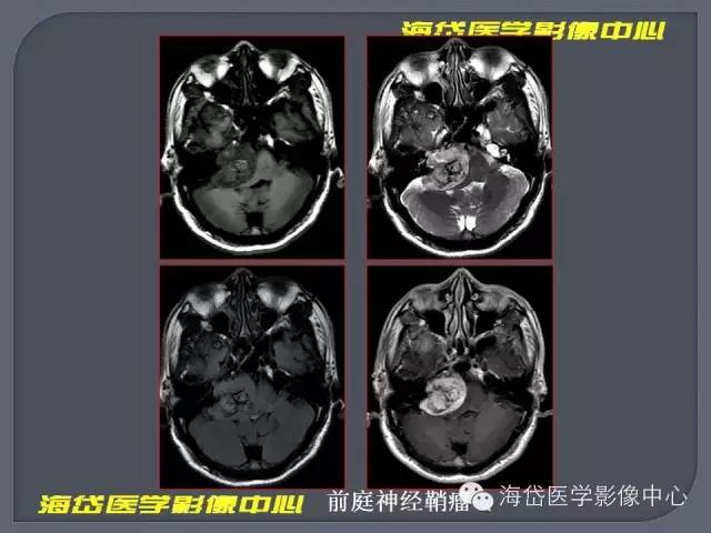 【PPT】基于MR增强扫描的桥小脑角区病变的影像学诊断