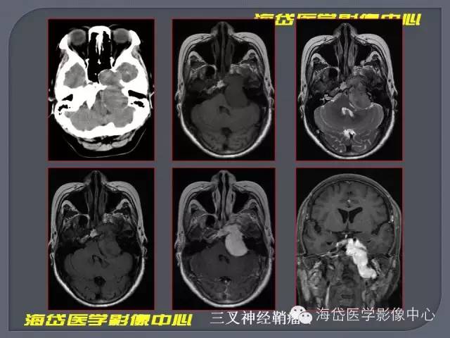 【PPT】基于MR增强扫描的桥小脑角区病变的影像学诊断