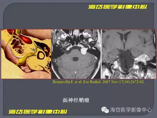 【PPT】基于MR增强扫描的桥小脑角区病变的影像学诊断