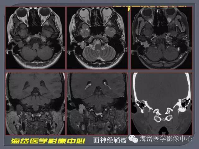 【PPT】基于MR增强扫描的桥小脑角区病变的影像学诊断