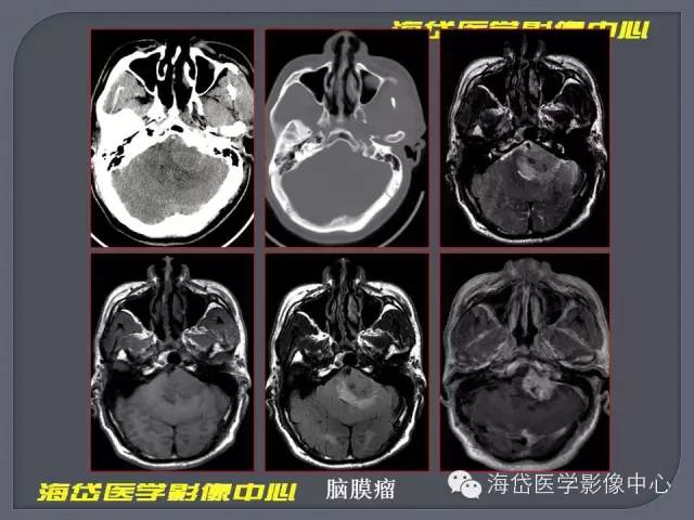【PPT】基于MR增强扫描的桥小脑角区病变的影像学诊断