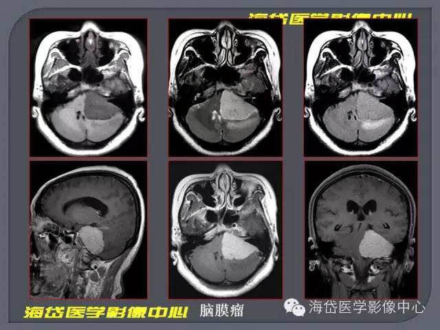 【PPT】基于MR增强扫描的桥小脑角区病变的影像学诊断