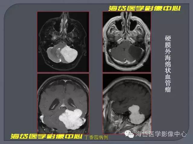 【PPT】基于MR增强扫描的桥小脑角区病变的影像学诊断