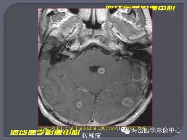 【PPT】基于MR增强扫描的桥小脑角区病变的影像学诊断