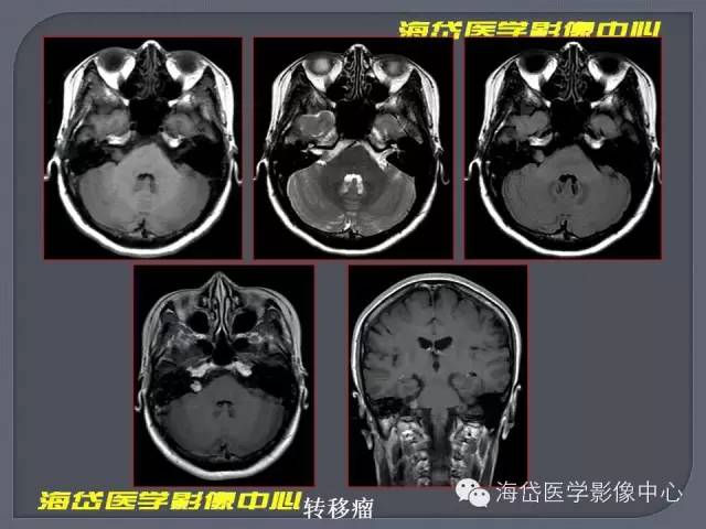 【PPT】基于MR增强扫描的桥小脑角区病变的影像学诊断
