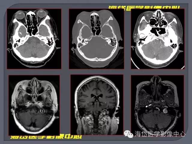 【PPT】基于MR增强扫描的桥小脑角区病变的影像学诊断