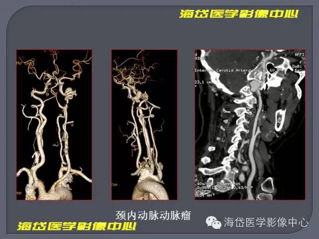 【PPT】基于MR增强扫描的桥小脑角区病变的影像学诊断