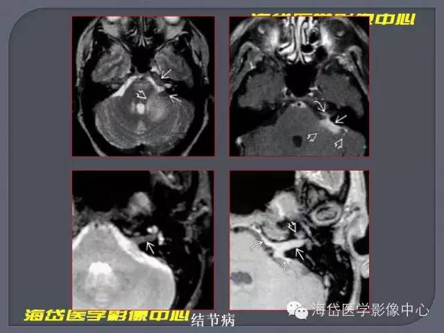 【PPT】基于MR增强扫描的桥小脑角区病变的影像学诊断