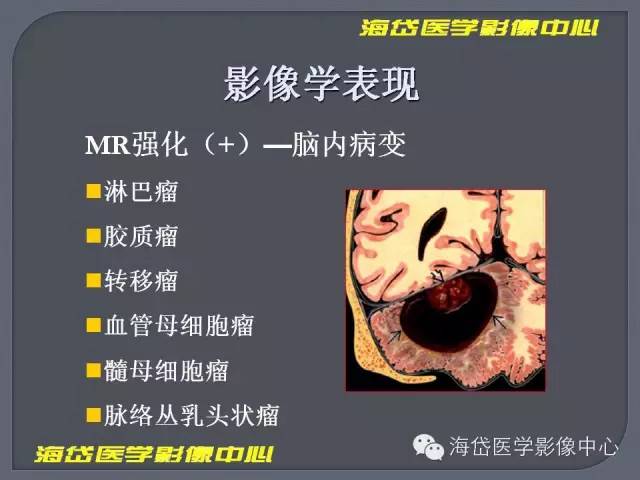【PPT】基于MR增强扫描的桥小脑角区病变的影像学诊断