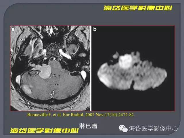 【PPT】基于MR增强扫描的桥小脑角区病变的影像学诊断