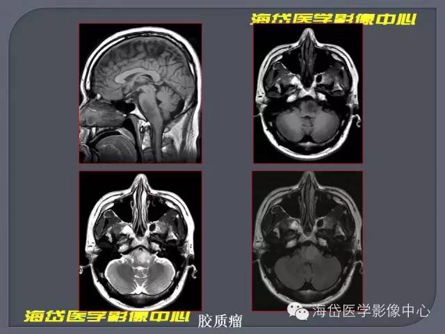 【PPT】基于MR增强扫描的桥小脑角区病变的影像学诊断