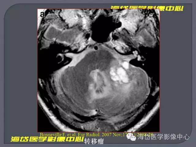 【PPT】基于MR增强扫描的桥小脑角区病变的影像学诊断