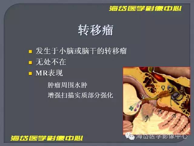 【PPT】基于MR增强扫描的桥小脑角区病变的影像学诊断