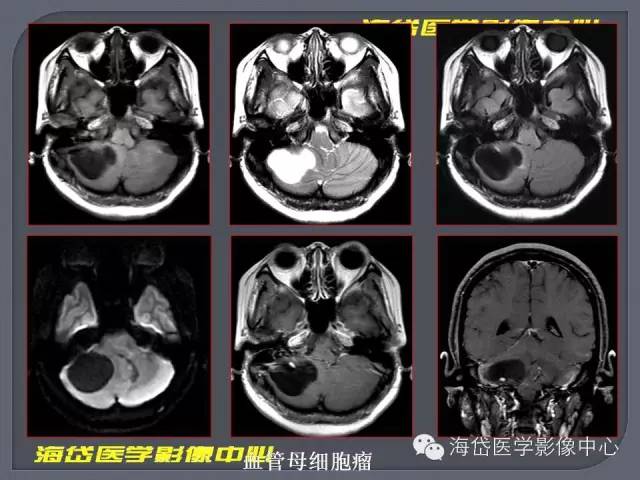【PPT】基于MR增强扫描的桥小脑角区病变的影像学诊断