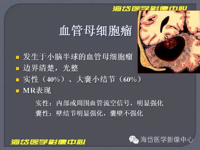 【PPT】基于MR增强扫描的桥小脑角区病变的影像学诊断