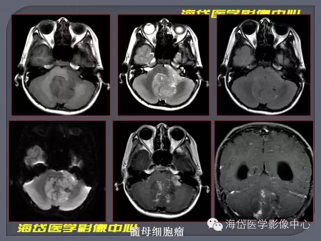 【PPT】基于MR增强扫描的桥小脑角区病变的影像学诊断
