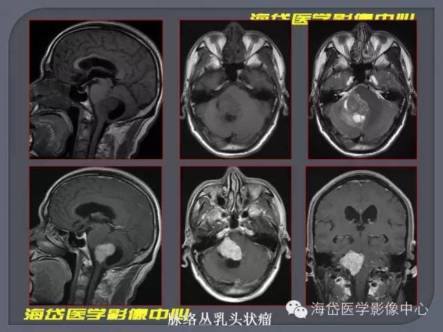 【PPT】基于MR增强扫描的桥小脑角区病变的影像学诊断