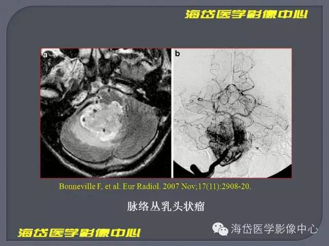 【PPT】基于MR增强扫描的桥小脑角区病变的影像学诊断