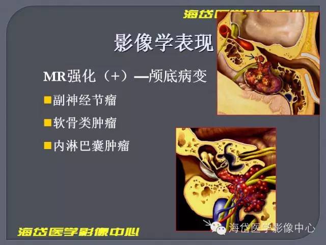 【PPT】基于MR增强扫描的桥小脑角区病变的影像学诊断