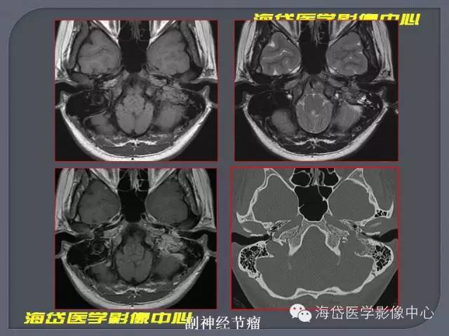 【PPT】基于MR增强扫描的桥小脑角区病变的影像学诊断