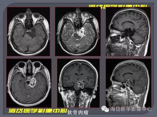 【PPT】基于MR增强扫描的桥小脑角区病变的影像学诊断