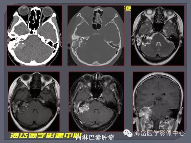 【PPT】基于MR增强扫描的桥小脑角区病变的影像学诊断