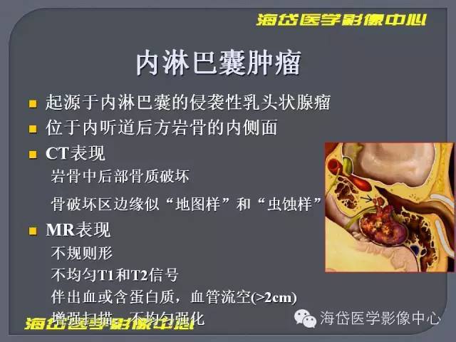 【PPT】基于MR增强扫描的桥小脑角区病变的影像学诊断