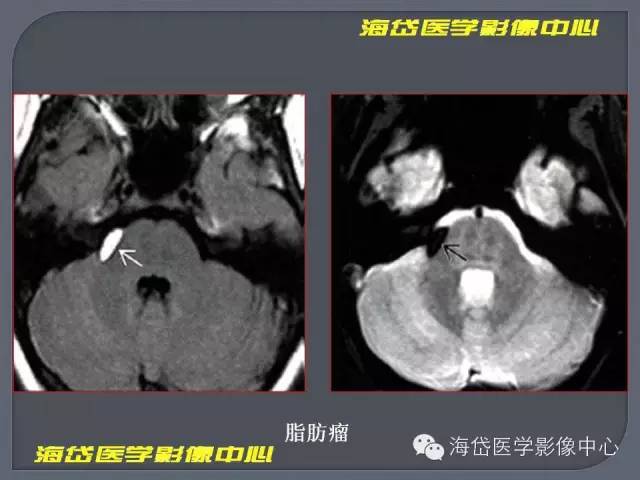 【PPT】基于MR增强扫描的桥小脑角区病变的影像学诊断