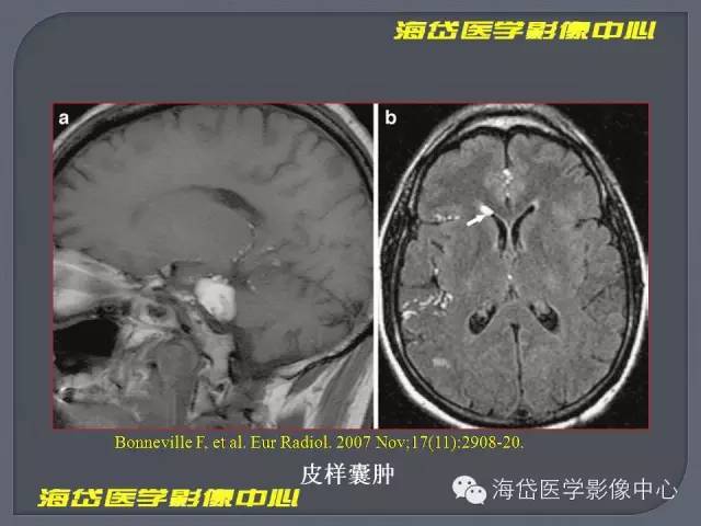【PPT】基于MR增强扫描的桥小脑角区病变的影像学诊断