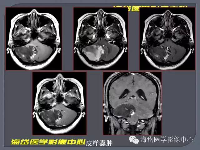 【PPT】基于MR增强扫描的桥小脑角区病变的影像学诊断