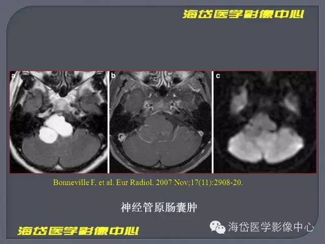 【PPT】基于MR增强扫描的桥小脑角区病变的影像学诊断