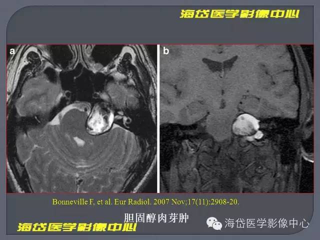 【PPT】基于MR增强扫描的桥小脑角区病变的影像学诊断