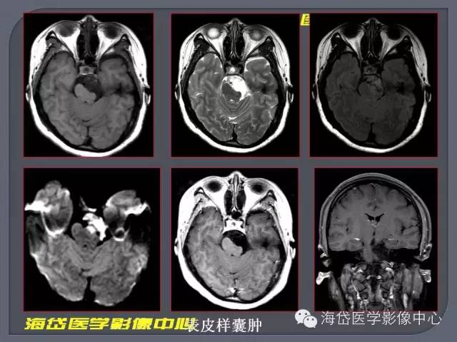 【PPT】基于MR增强扫描的桥小脑角区病变的影像学诊断